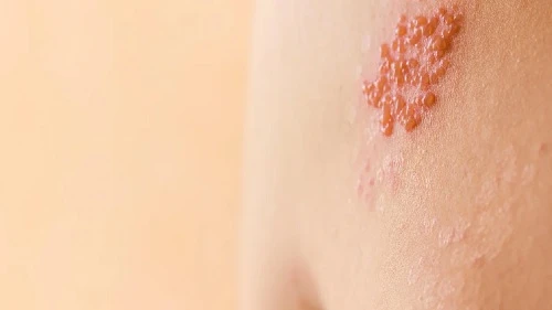 افزایش قابل توجه احتمال بروز سکته قلبی و مغزی با ابتلا به بیماری زونا