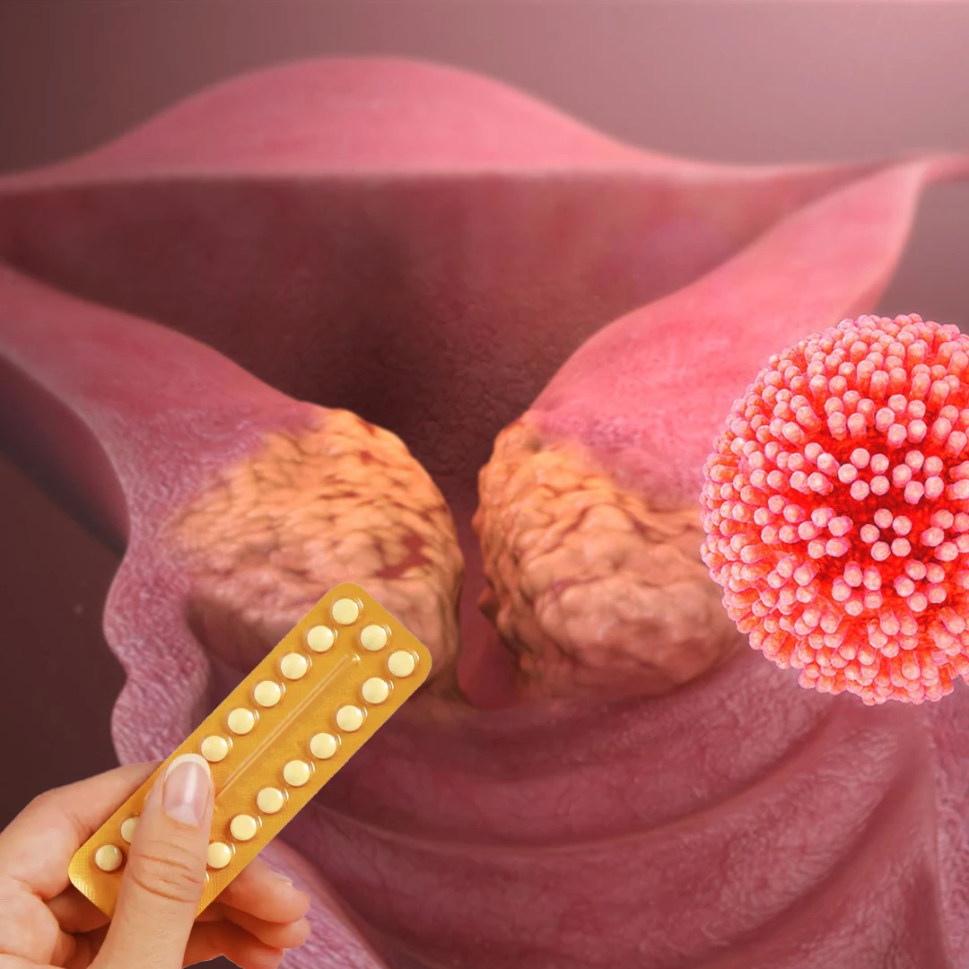 ارتباط بین خطر ابتلا به HPV و داروهای پیشگیری از بارداری هورمونی