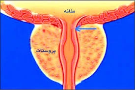 از التهاب پروستات یا پروستاتیت چه می دانید؟