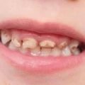 همه چیز درباره پوسیدگی دندان