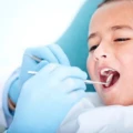 فیشورسیلانت چیست و چگونه به دندان‌های کودکان در مقابله با پوسیدگی کمک می‌کند؟