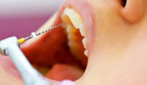 جلسه مرور تدریس صفر تا صد عصب کشی