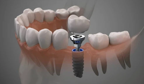 مرور جلسه 6 و 7 دندان