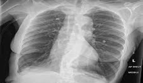 وبینار علمی بيماريهاي انسدادي مزمن ريه (COPD)