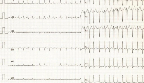 وبینار علمی تفسیر نوار قلب (ECG) در بلوک‌های قلبی، هیپرتروفی‌ها و انفارکتوس میوکارد (MI)