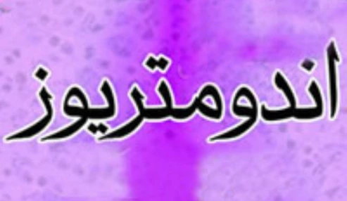 وبینار علمی آندومتریوز، پیش آگهی و تشخیص