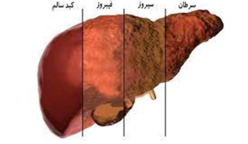 وبینار علمی بیماری کبد چرب و سیروز الکلی