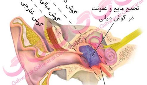 وبینار علمی  ضایعات التهابی گوش خارجی