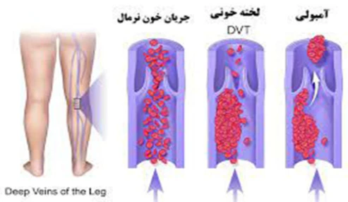 وبینار علمی  DVT (علائم ، تشخیص و درمان های دارویی)
