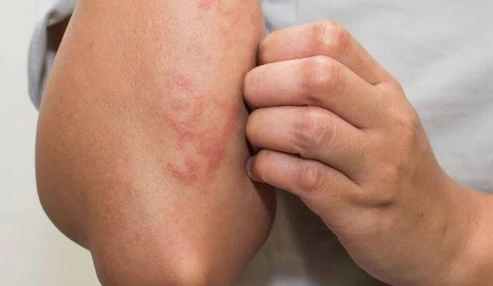 وبینار علمی  برخی بیماریهای شایع پوستی