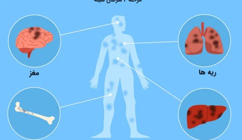 وبینار علمی  کانسرهای متاستاتیک پستان