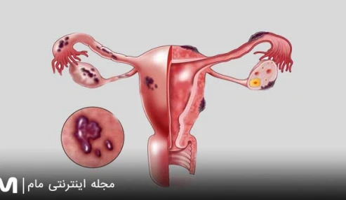 وبینار علمی آندومتریوز، پیش آگهی و تشخیص