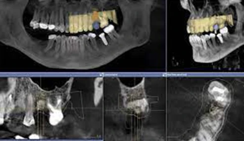 وبینار علمی کاربرد CBCT در بررسی ناحیه فک و صورت