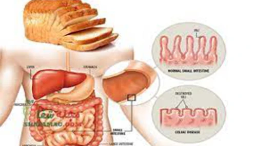 وبینار علمی بیماری سلیاک