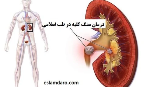وبینار علمی مداخلات طب سنتی- ایرانی در سنگ کلیه