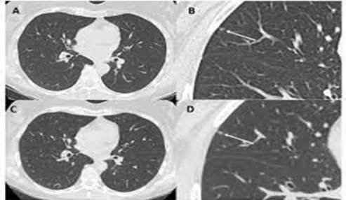 وبینار علمی Lung metastasis and benign tumor