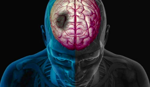وبینار علمی سکته حاد میوکارد