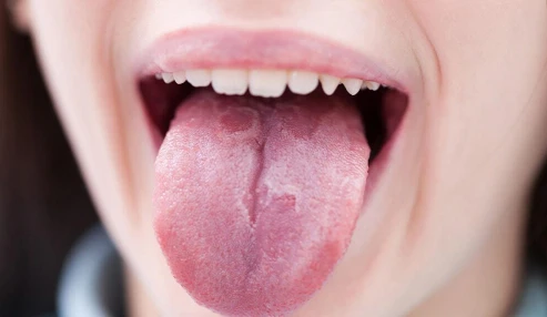 وبینار علمی ضایعات سفید و قرمز حفره دهان