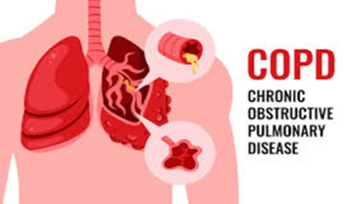 وبینار علمی تازه های COPD