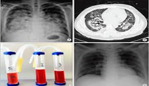 وبینار علمی Uremic Lung