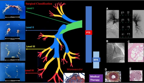 وبینار علمی Perioperative management of pte