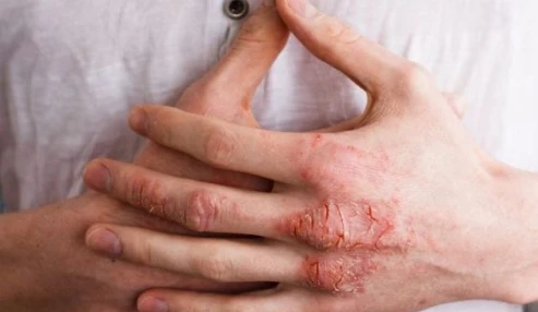 وبینار علمی دارو درمانی عفونت های پوستی