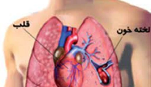 وبینار علمی معضلات درمانی آمبولی حاد ریه