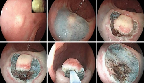 برنامه Practical Electrosurgery در گوارش