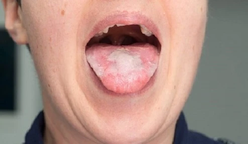 علائم دهانی و راهکارهای درمانی HPV
