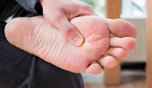 وبینار علمی دارودرمانی میخچه، زگیل و سوختگی‌های پوستی