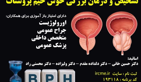 تشخیص و درمان بزرگی خوش خیم پروستات