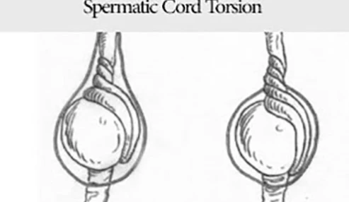 Spermatic Cord Torsion