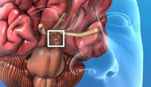 وبینار علمی تومور های هیپوفیز