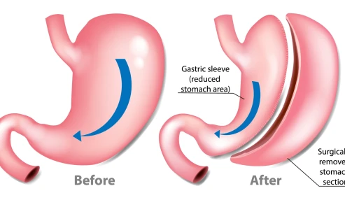 وبینار علمی جلسه جراحان چاقی و متابولیک