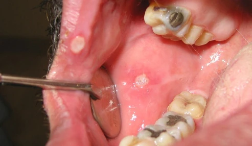 وبینار علمی تشخیص و درمان ضایعات پیش بدخیم دهان